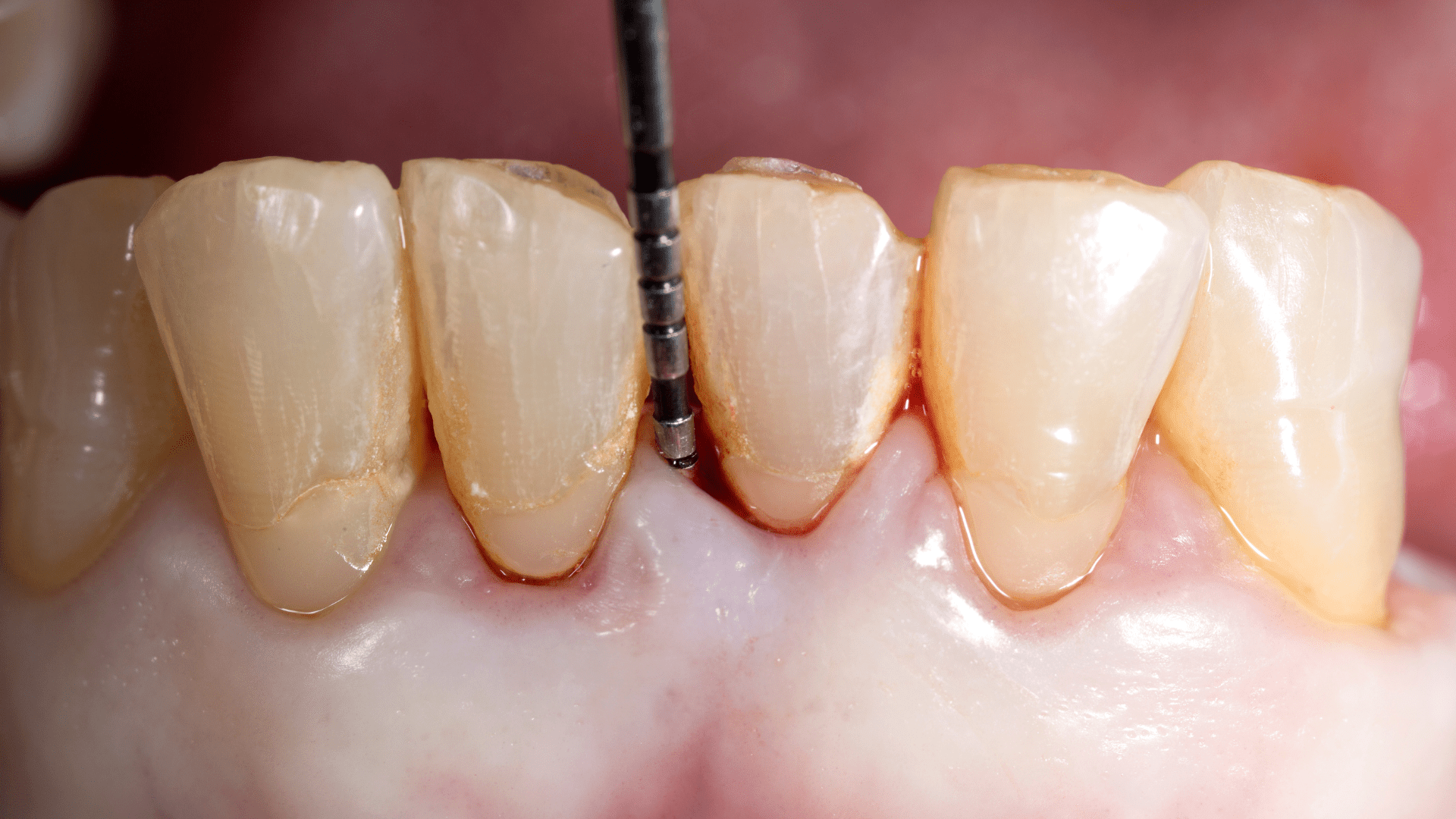 Periodontitis